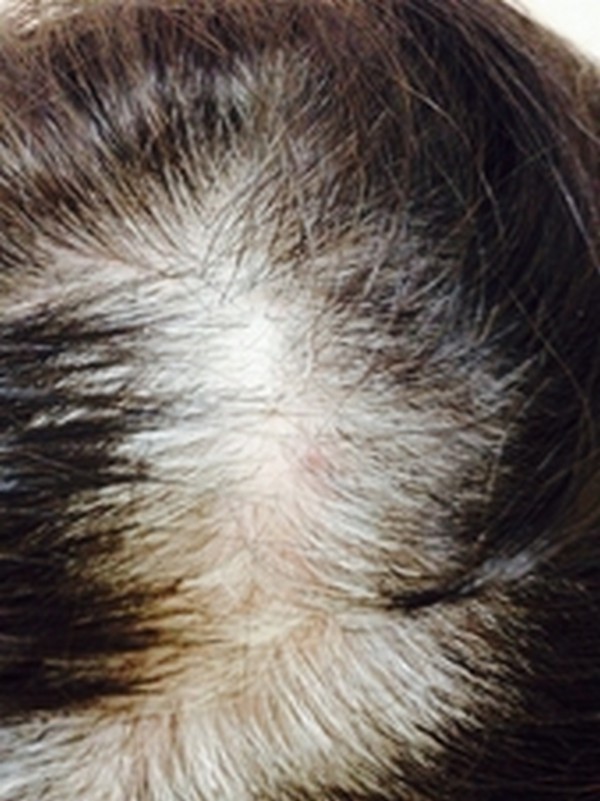 Плазмолифтинг волосистой части головы (до)