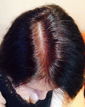 Плазмолифтинг волосистой части головы (после)
